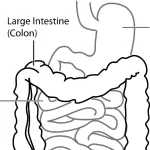 Stomach Inflammatory Fibroid Polyp (IFP)